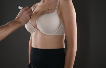 A plastic surgeon marking patient's skin before cosmetic breast surgery..