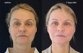 female patient before and after EVELIFT®