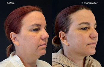 female patient before and after EVELIFT®