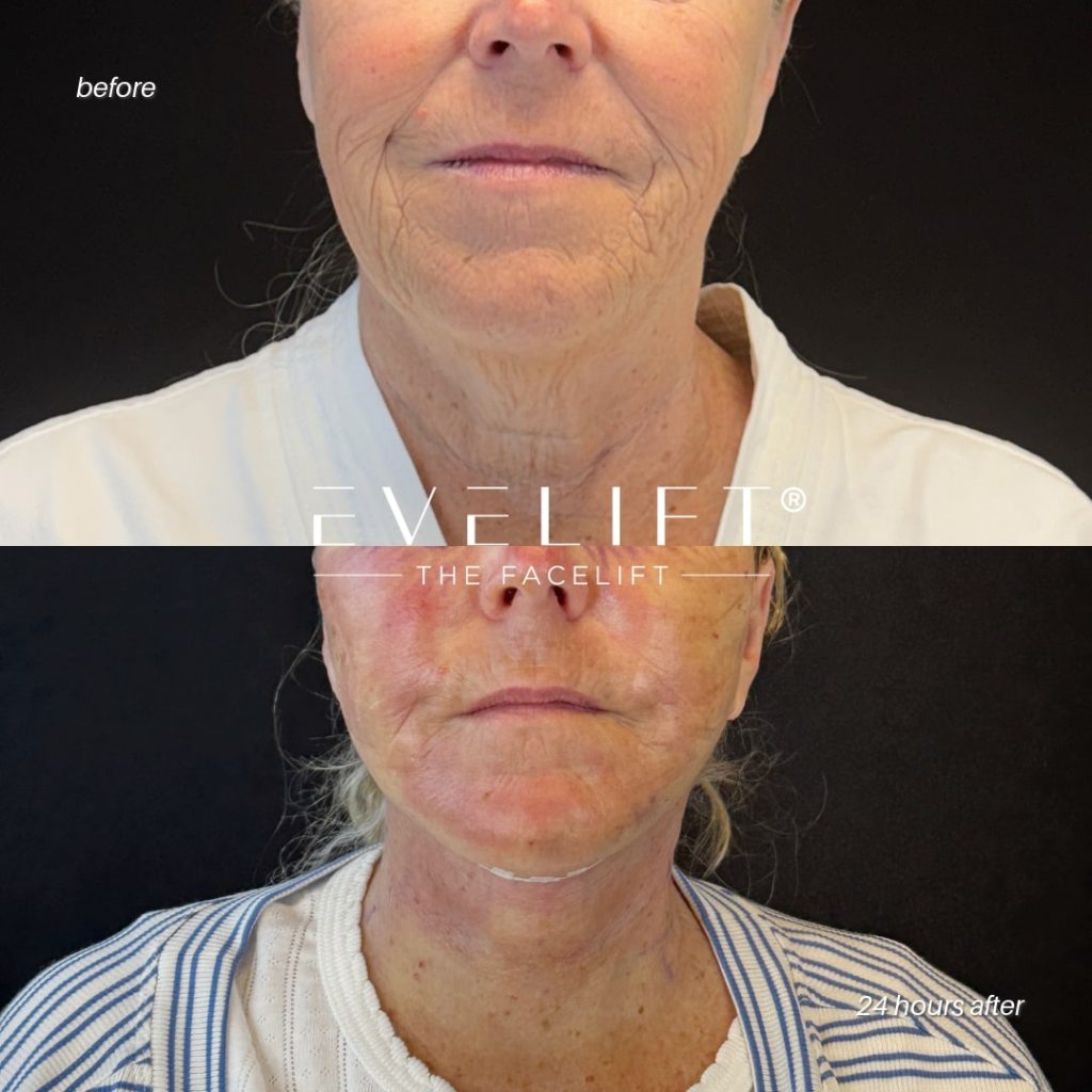 female patient before and after EVELIFT®