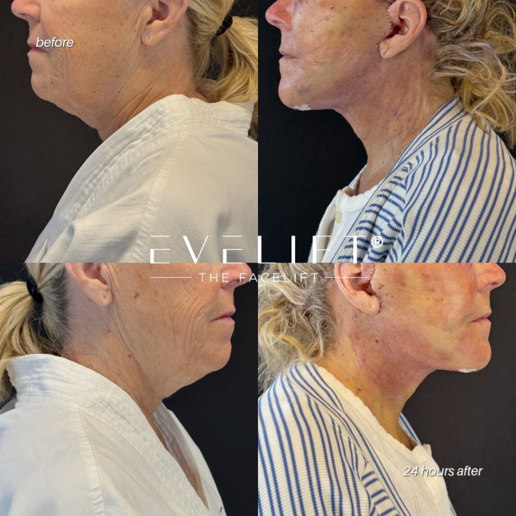 female patient before and after EVELIFT®
