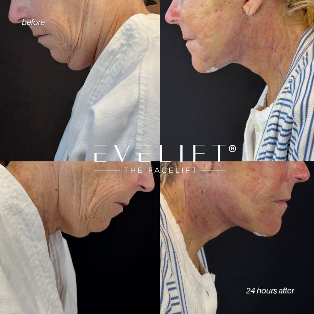 female patient before and after EVELIFT®