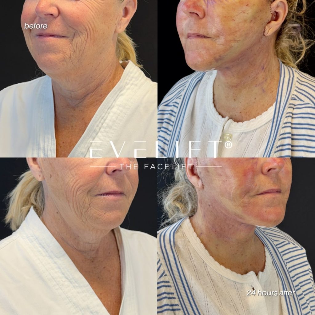 female patient before and after EVELIFT®