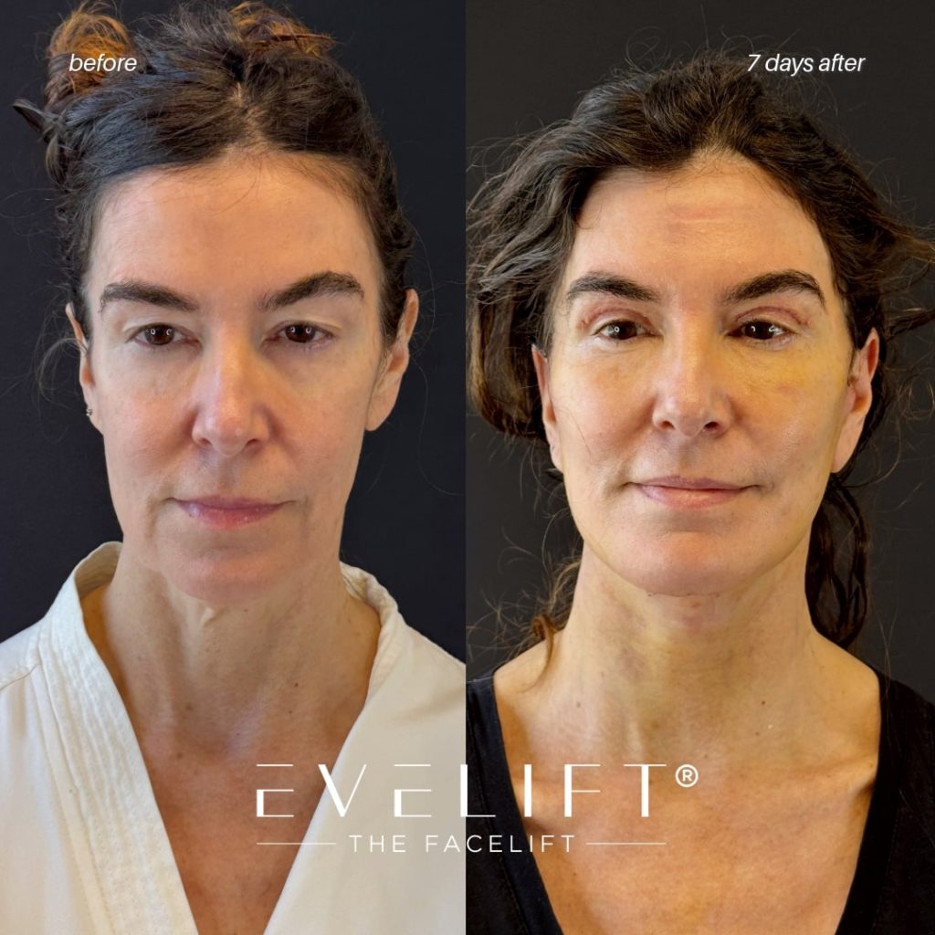 female patient before and after EVELIFT®