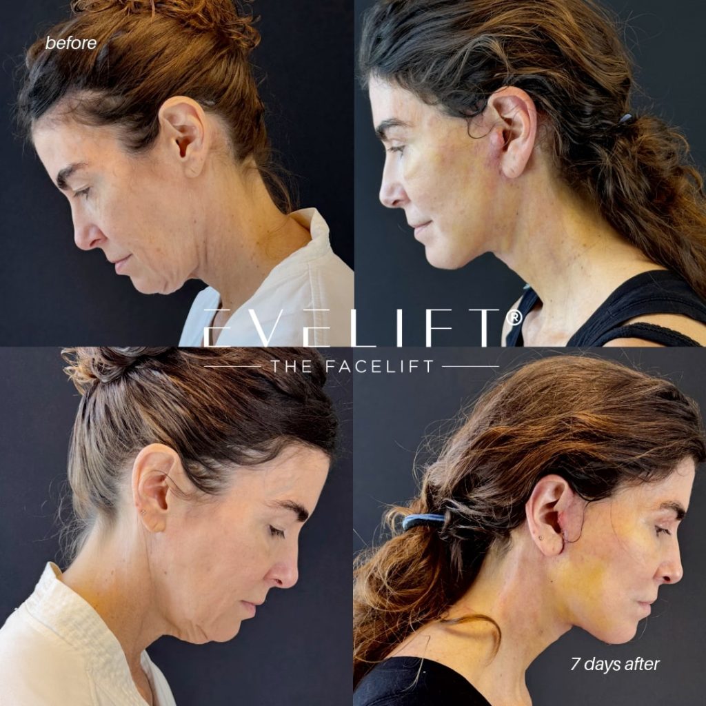 female patient before and after EVELIFT®