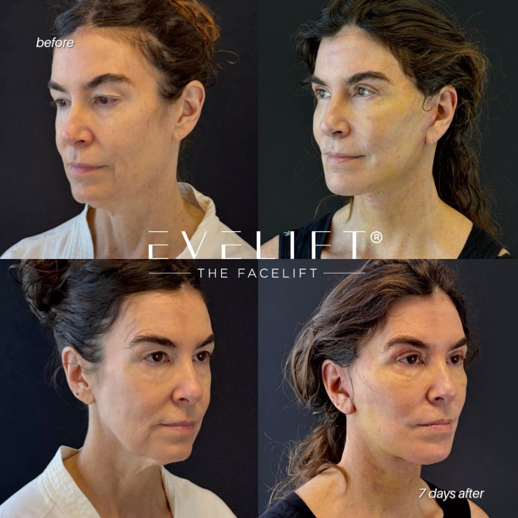female patient before and after EVELIFT®