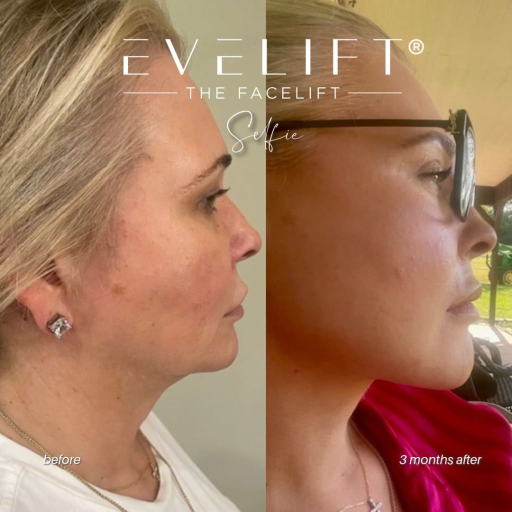 female patient before and after EVELIFT®