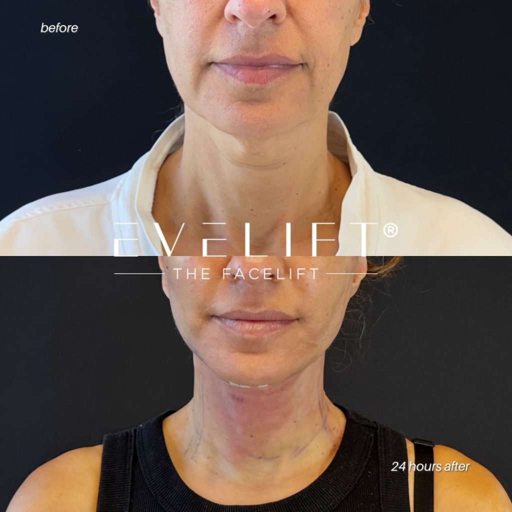 female patient before and after EVELIFT®