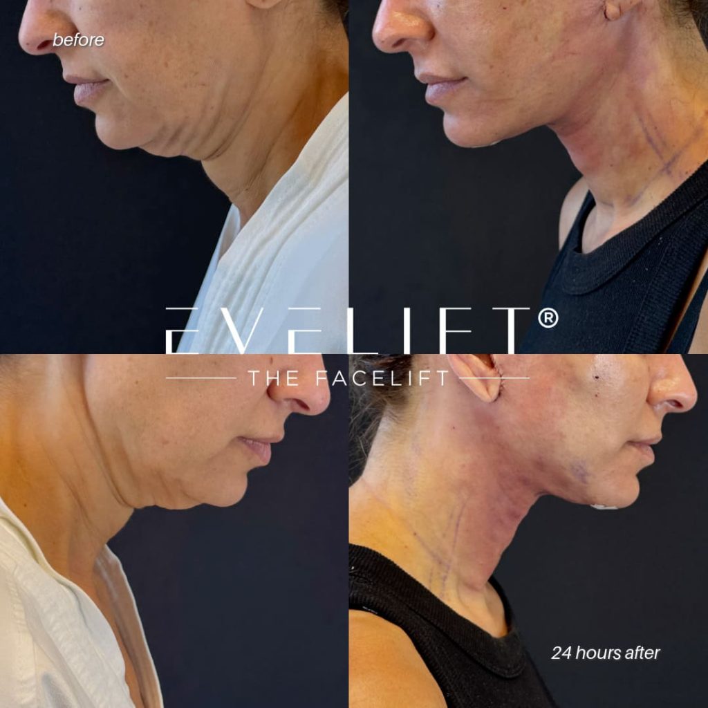 female patient before and after EVELIFT®
