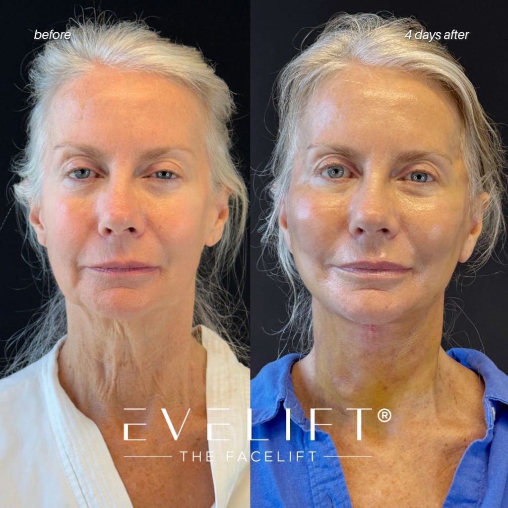female patient before and after EVELIFT®