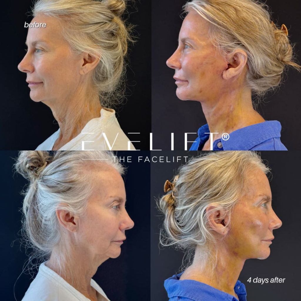 female patient before and after EVELIFT®