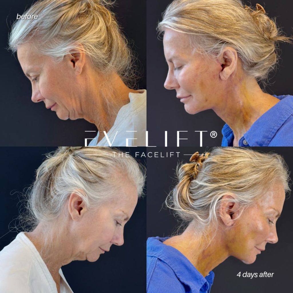 female patient before and after EVELIFT®