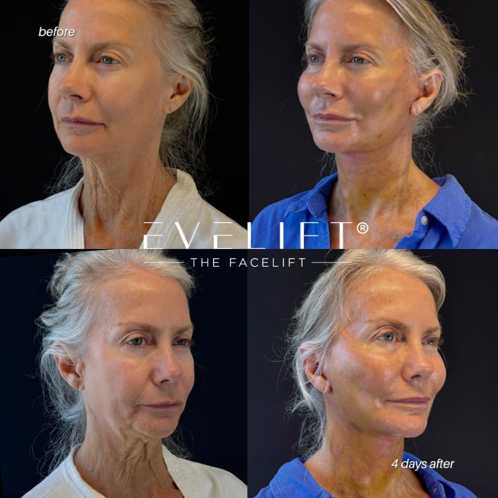 female patient before and after EVELIFT®
