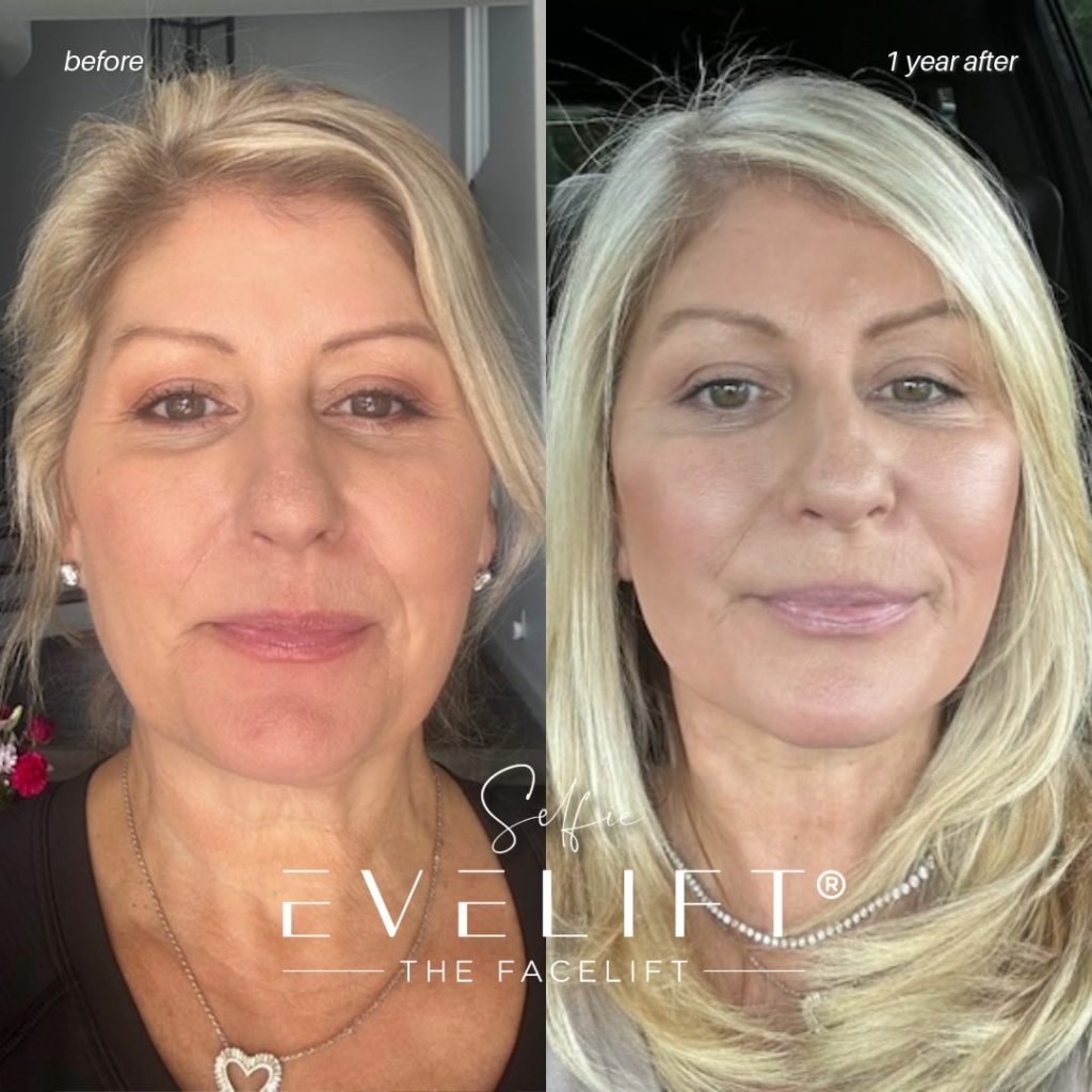 female patient before and after EVELIFT®