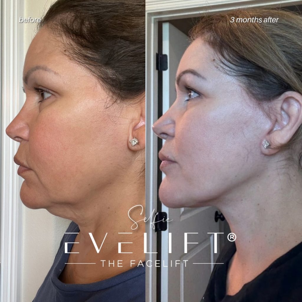 female patient before and after EVELIFT®