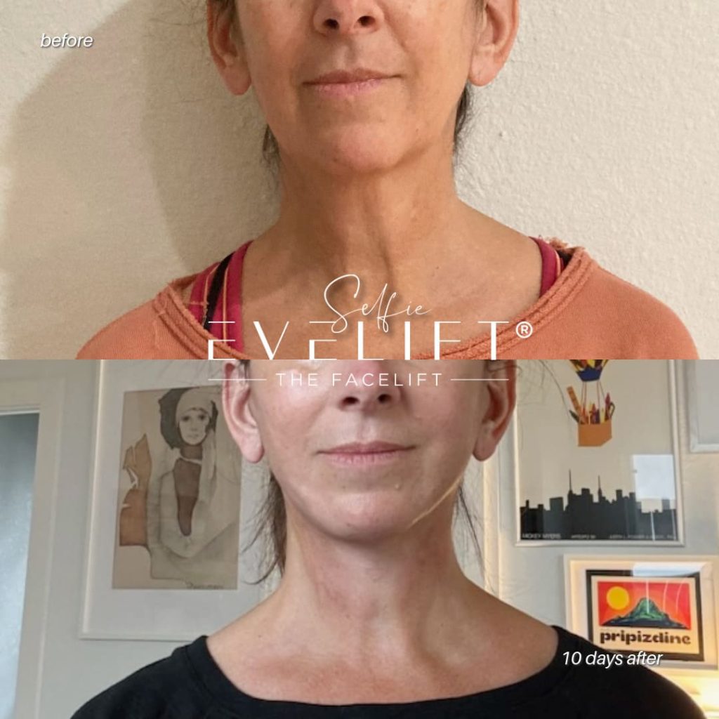 female patient before and after EVELIFT®