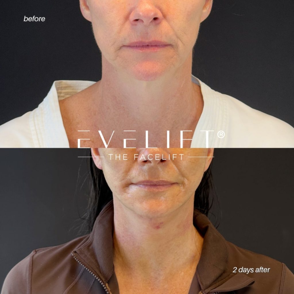 female patient before and after EVELIFT®